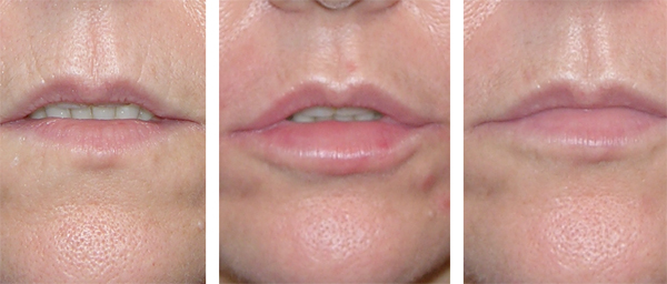 Ageing Lips restored by Sue Ibrahim