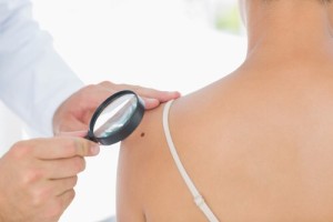Woman has her moles checked by a professional - Mole checking is essential says Sue Ibrahim the nurse consultant in dermatology from Elan Medical Clinics in central London and Essex