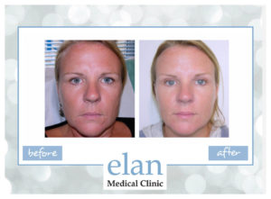 This woman was treated with Restylane skin fillers by Sue Ibrahim. Photos taken 3 weeks apart