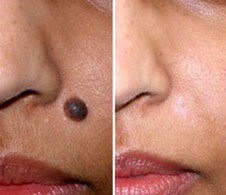 Facial mole removal in Essex & London - Mole removal London - Cyst removal London